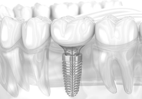 Dental implant in the middle of a tooth, surrounded by a group of teeth